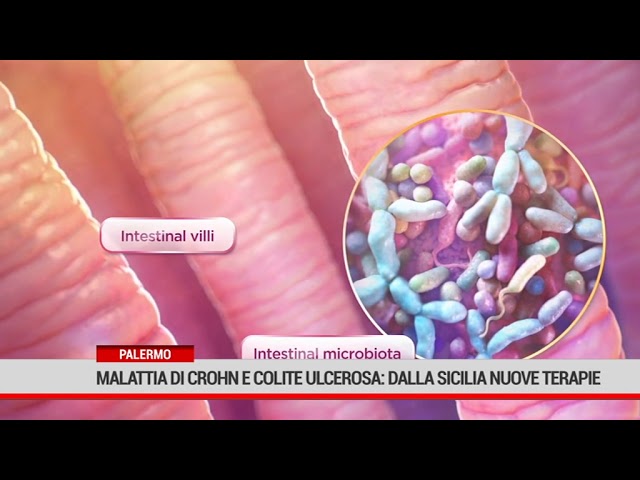 Palermo. Malattia di Crohn e Colite Ulcerosa: dalla Sicilia nuove terapie